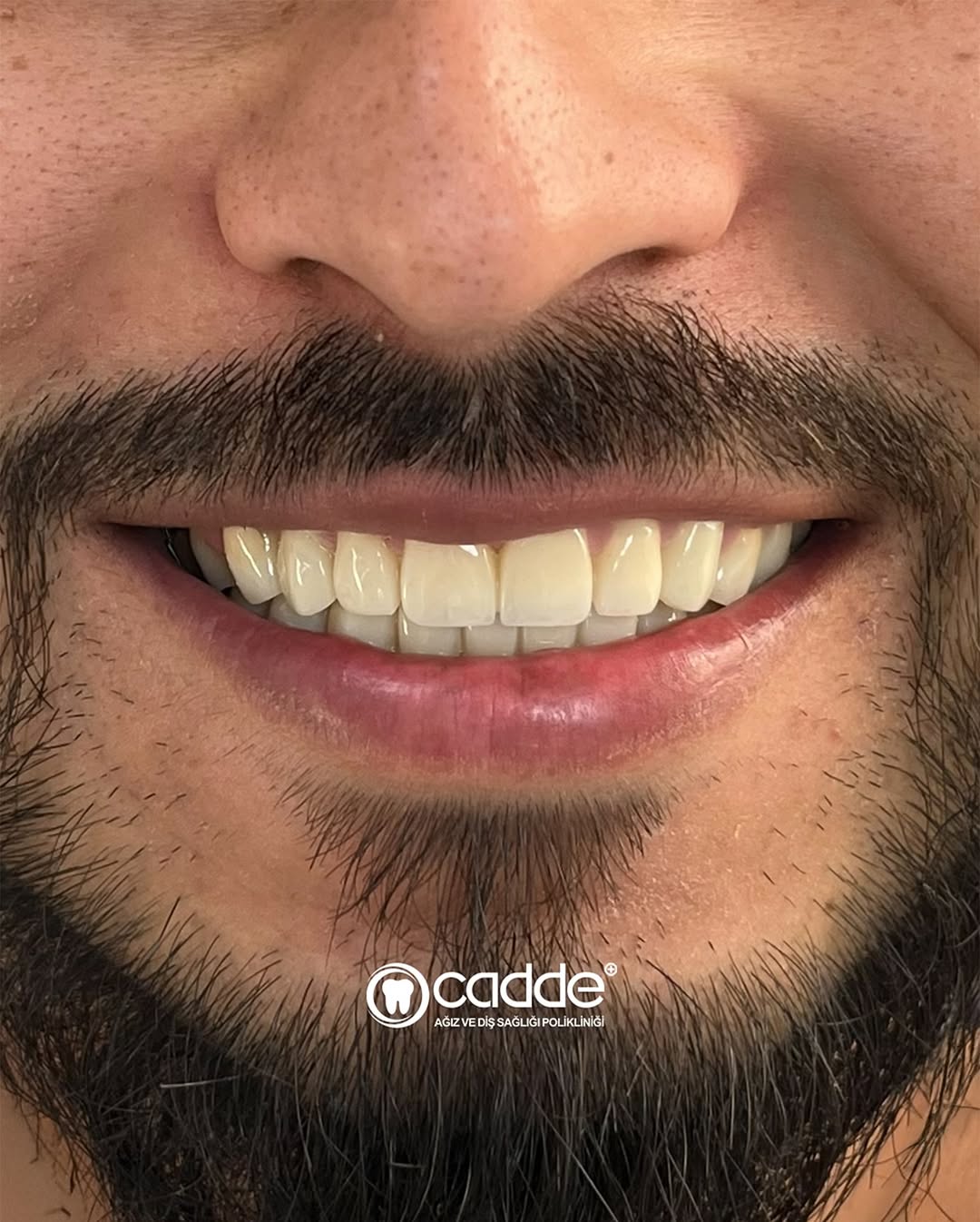 Dişlerindeki ileri düzey madde kaybı ve çürükler nedeniyle kliniğimize başvuran hastamız için ka (1)