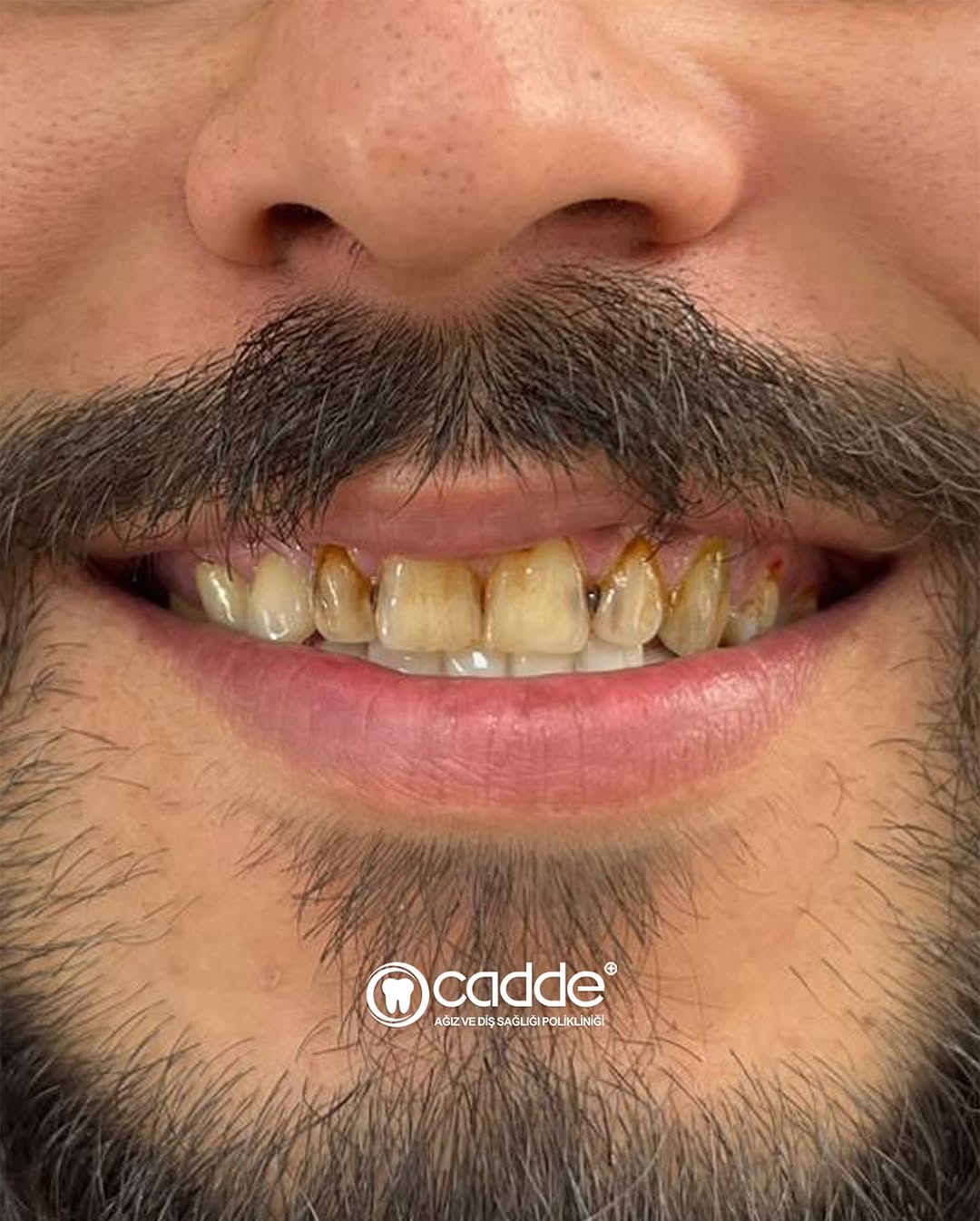 Dişlerindeki ileri düzey madde kaybı ve çürükler nedeniyle kliniğimize başvuran hastamız için ka