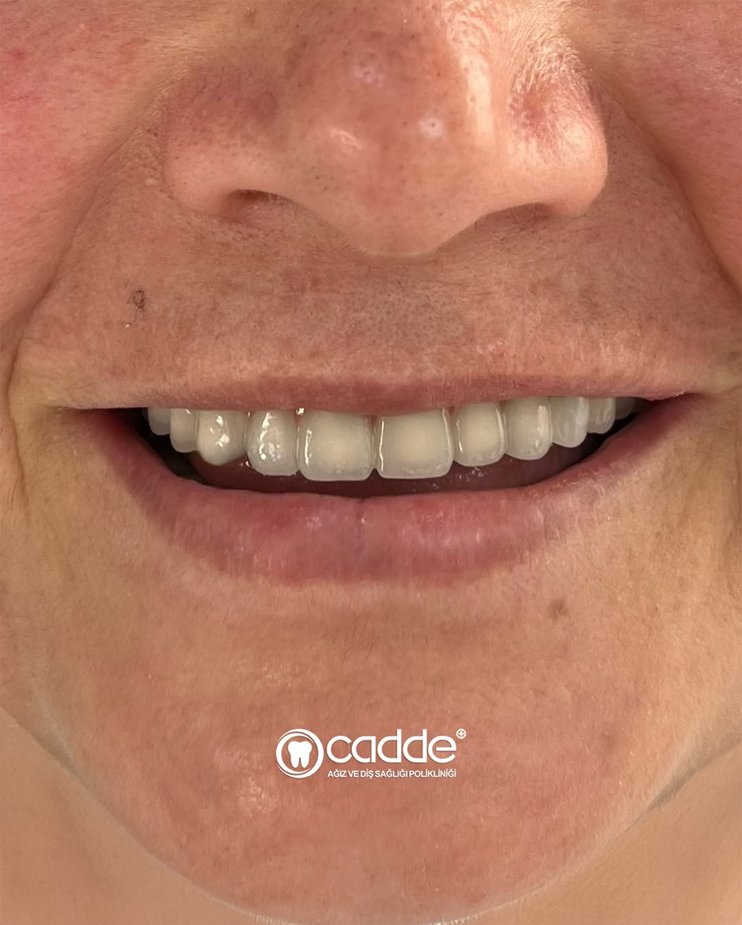 Gülüşten Yüze Uzanan Estetik Denge. ✨Hastamızda diş desteği azaldığı için dudak ve ağız çevresin (1)
