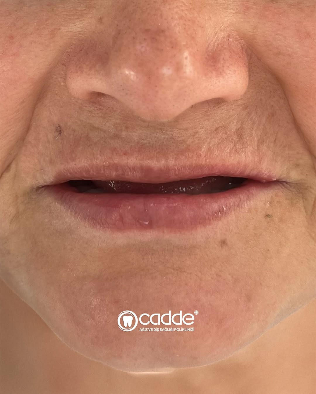 Gülüşten Yüze Uzanan Estetik Denge. ✨Hastamızda diş desteği azaldığı için dudak ve ağız çevresin