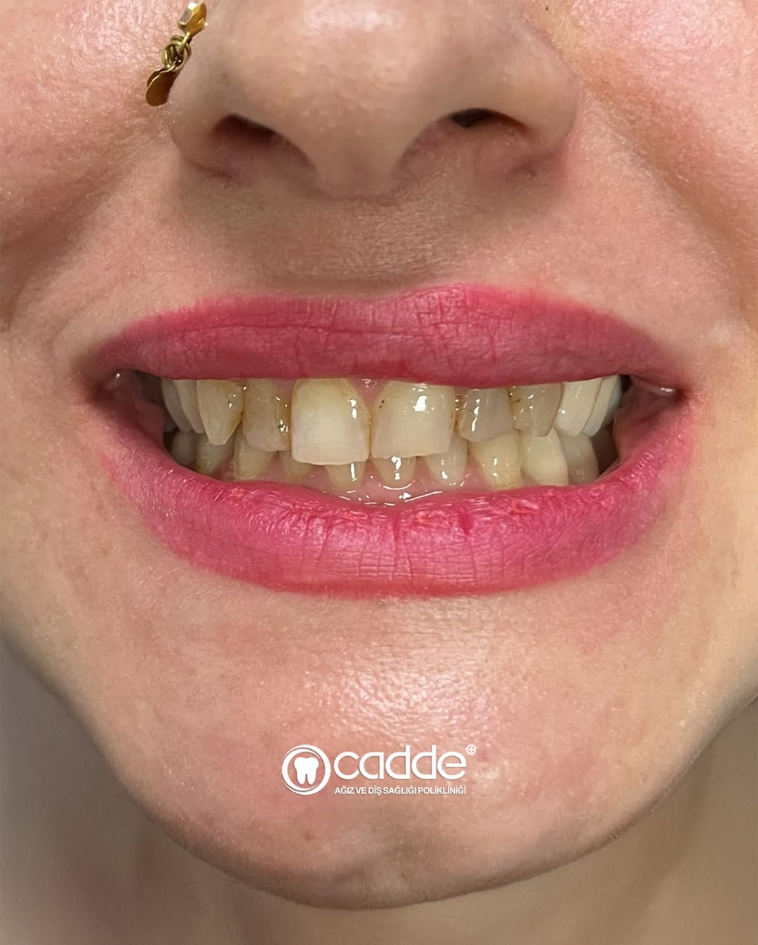 ✨ Hastamızın dolgu ve kanal tedavilerine bağlı oluşan renklenme ve boyut kayıpları, zirkonyum re (1)