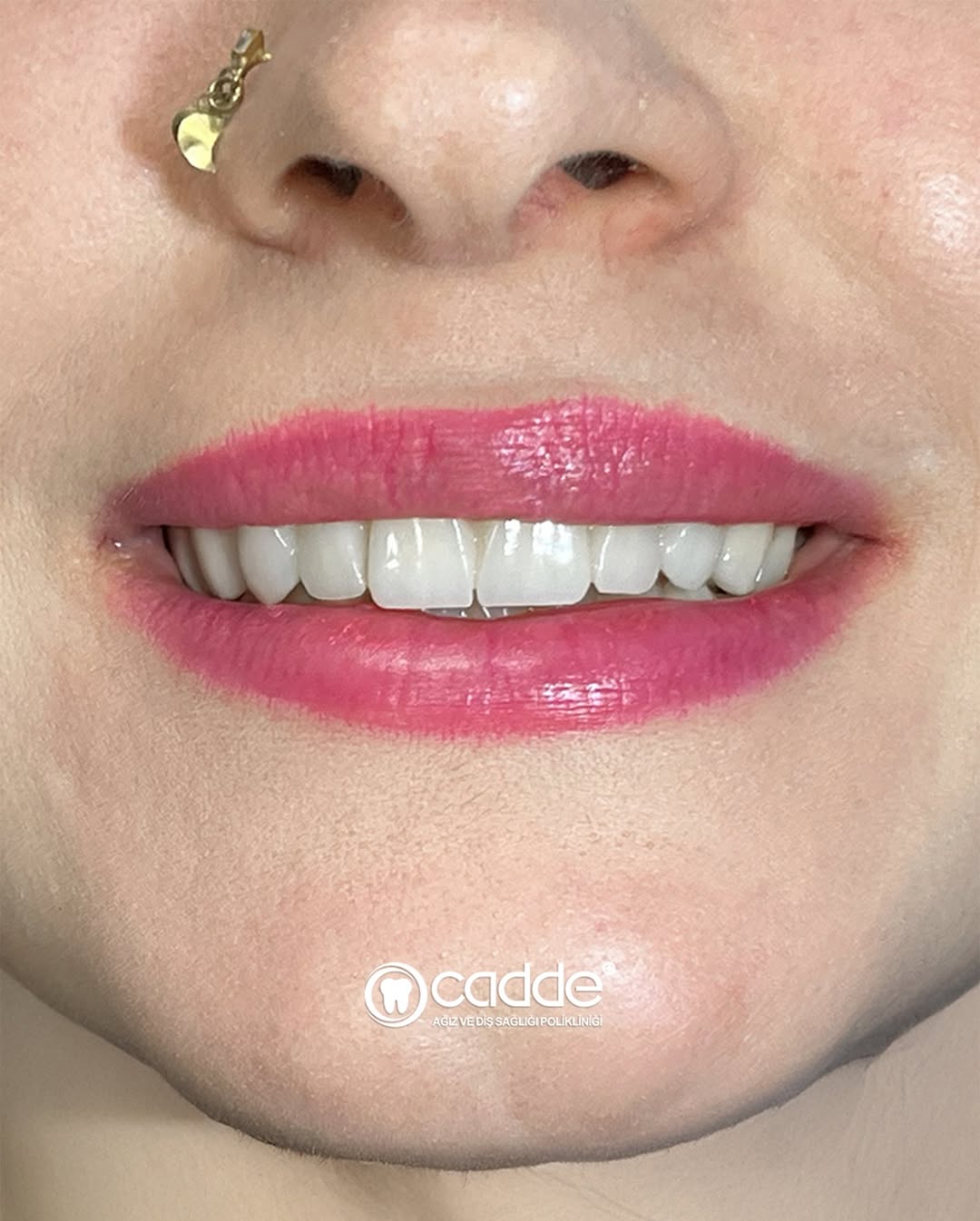 ✨ Hastamızın dolgu ve kanal tedavilerine bağlı oluşan renklenme ve boyut kayıpları, zirkonyum re